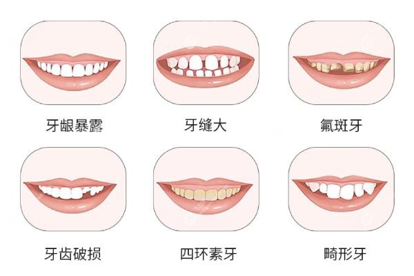 牙齿贴面.jpg
