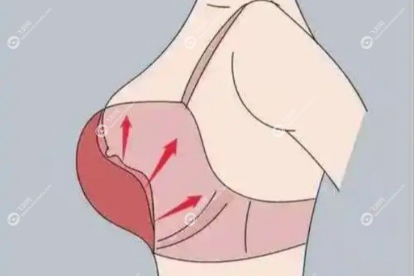 乳房悬吊提升手术可以微创吗