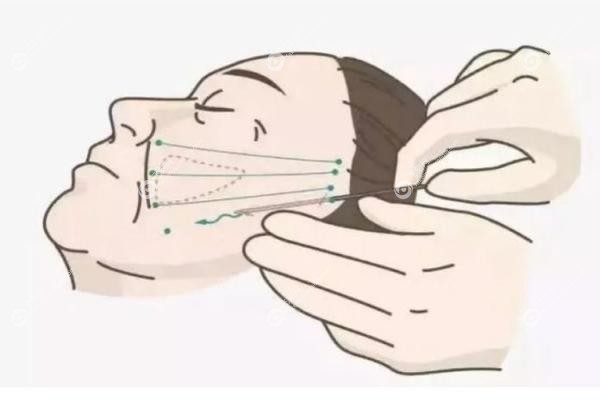 小拉皮手术多少钱一次.jpg