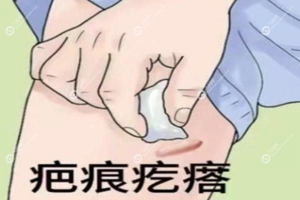 广州治疗疤痕疙瘩哪家医院好.jpg