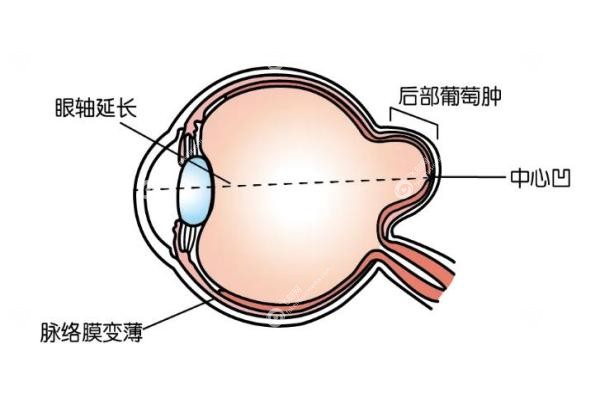 封康后巩膜加固手术效 果揭秘:2400度近视患者的真实经历与就诊指南3 封康后巩膜加固手术效 果揭秘:2400度近视患者的真实经历与就诊指南3