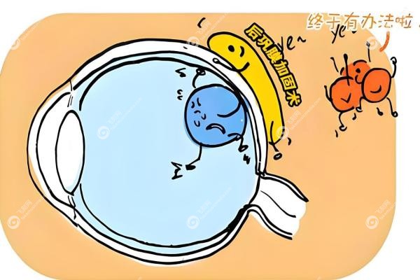 封康后巩膜加固手术效 果揭秘:2400度近视患者的真实经历与就诊指南 封康后巩膜加固手术效 果揭秘:2400度近视患者的真实经历与就诊指南