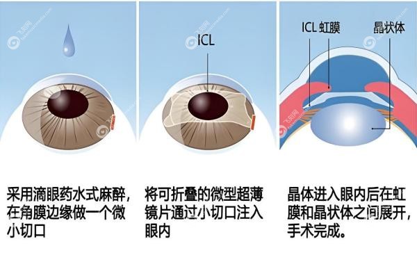 重庆做ICL晶体植入去哪里医院？南坪爱尔/佰视佳/爱成眼科等医院排名前十3