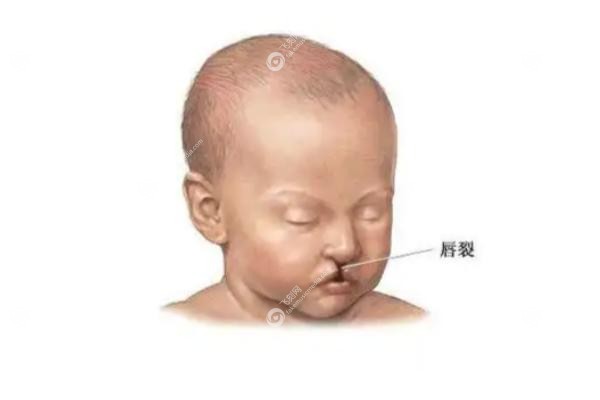 济南唇腭裂<span style=