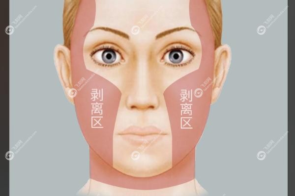 西安卢丙仑医生做的拉皮手术如何.jpg