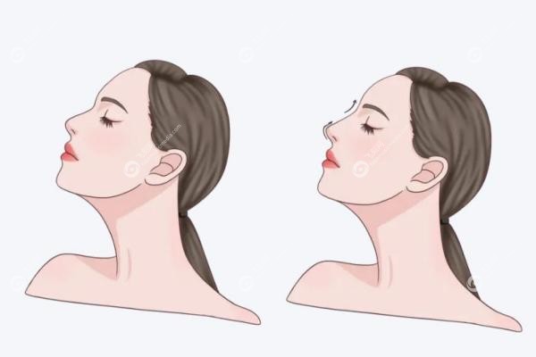 南京冯思阳肋软骨隆鼻亲历记：8万做的妈生鼻值不值？