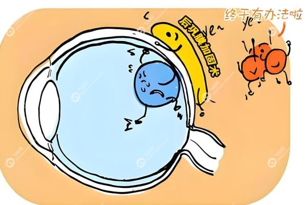 段安丽后巩膜加固术长期效 果追踪：5年眼轴零增长/国内排名前三,附年龄限制