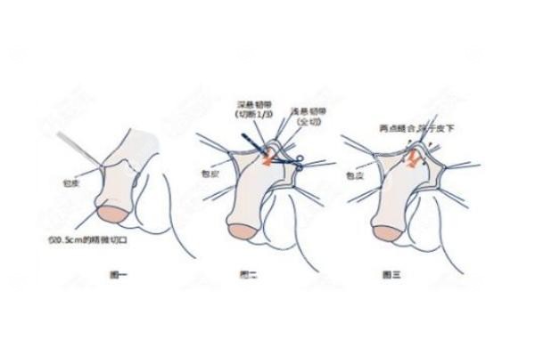 生物补片增粗手术.jpg