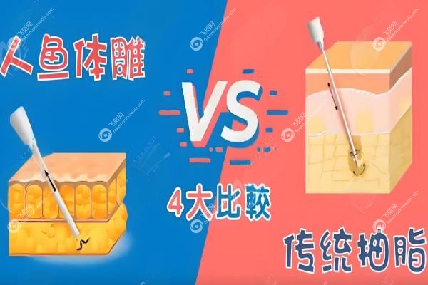 人鱼体雕VS普通吸脂：区别在哪？恢 复快吗？哪个更安 全？一篇看懂！
