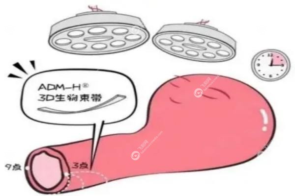 3D生物束带手术医院推荐.jpg
