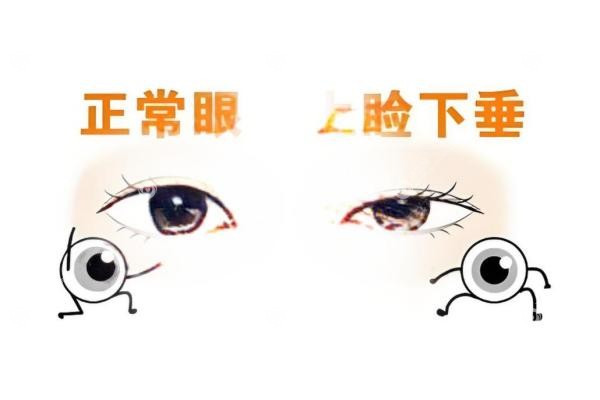 上眼睑下垂手术可以走医 保吗？报销条件+住院天数+术后恢 复全指南