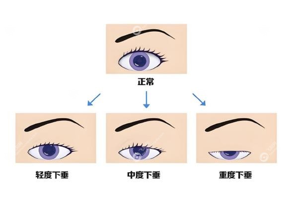 上眼睑下垂手术可以走医 保吗？报销条件+住院天数+术后恢 复全指南2