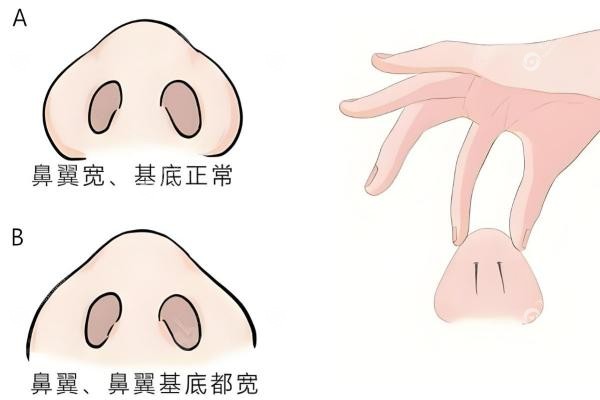 国内鼻修复专 家排名前十：刘彦军搭支架/范荣杰救挛缩，对症选人！3