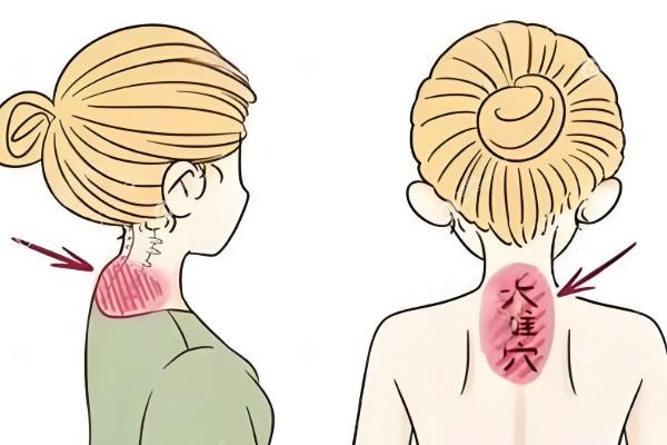 曹孟君医生做富贵包怎么样.jpg