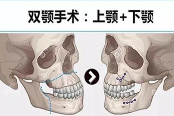 国内双鄂手术医院排名.jpg