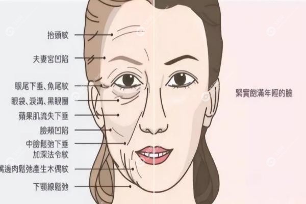 穆宝安面部提升技术如何？微创自然，V美减龄保持8年+,拉皮价格/效 果案 例揭秘！3