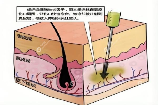 丁小邦取生长因子到底怎么样？微创技术取得干净,复发率极低,附价格+口碑案 例3