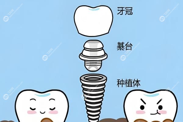 常州佧瓦口腔种植牙怎么样？微创<span style=