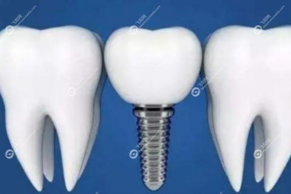 国产创英种植牙质量可靠吗.jpg 国产创英种植牙质量可靠吗.jpg