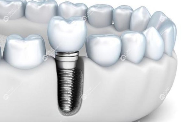 国产创英种植牙质量可靠吗.jpg 国产创英种植牙质量可靠吗.jpg