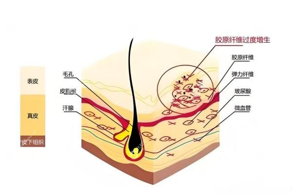 北京黎星医生取生长因子怎么样？微创2mm切口，3年零复发