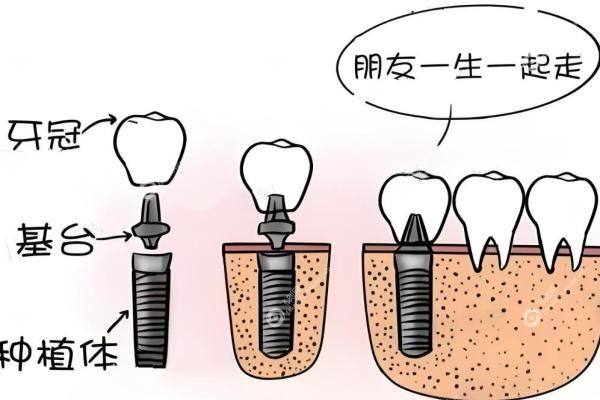 抖音种牙那么便宜真的假的？有猫腻，揭秘低价种牙背后的真相！3