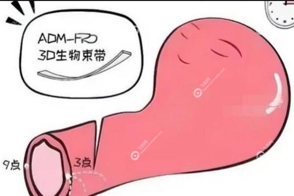 八爪鱼紧缩术与3D生物束带哪个好.jpg