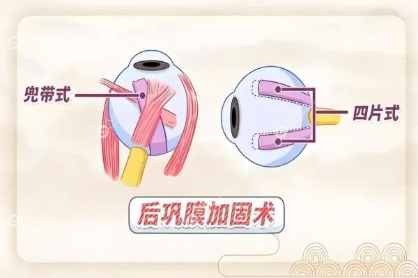封康后巩膜加固术国内排名前三，微创技术好，后期效 果稳，预约指南在这！2