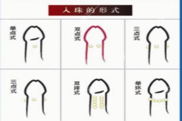 男士入珠手术一般入几颗.jpg