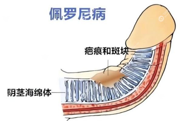 男士入珠手术一般入几颗.jpg