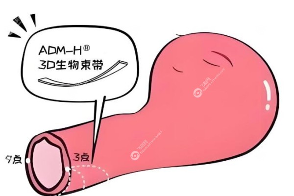 3d生物束带紧缩术好吗.jpg