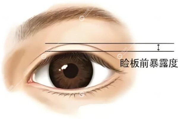 谭敏峰双眼皮真有那么美吗.jpg