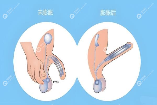 男士假体三件套可以控制时间吗？勃起≠延时！男士假体三件套的真实功能！