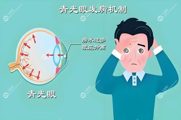 青光眼可以治 愈吗？真相揭秘！这些方法帮你稳住视力3