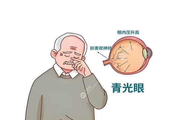 青光眼可以治 愈吗？真相揭秘！这些方法帮你稳住视力2