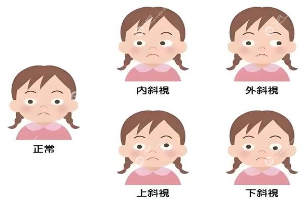 北京斜视手术医生排名前十：付晶/翟长斌等同仁