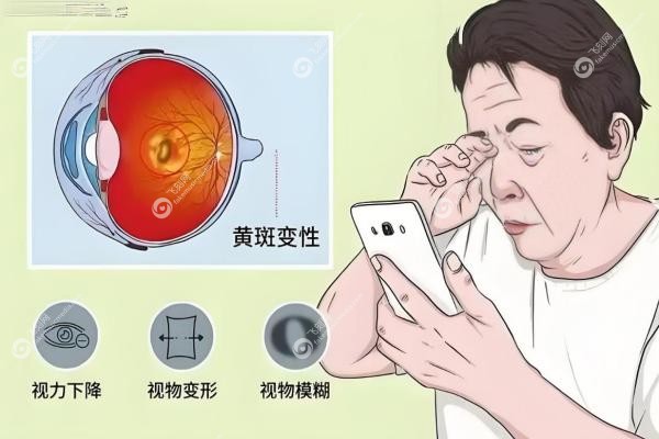 北京看眼底黄斑病变哪家医院好？同仁协和领 衔，私立茗视光等排名前十！3