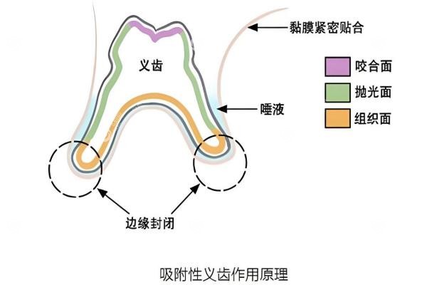 吸附性义齿有几种档次？经济/中端/高端3大档次全对比，这样选耐用又划算！2
