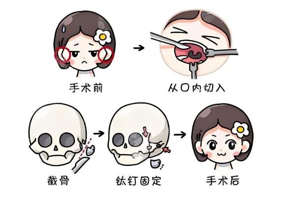 正颌手术是微创还是开刀？算是"精 准开刀"，2-5小时手术,分享真实恢 复经历！