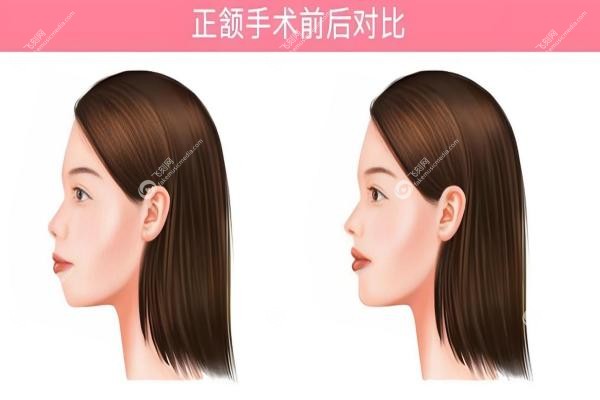 正颌手术是微创还是开刀？算是"精 准开刀"，2-5小时手术,分享真实恢 复经历！2