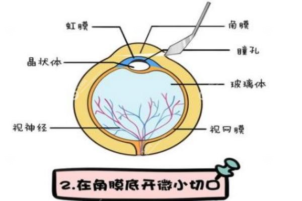 icl晶体植入十年后的危害.jpg
