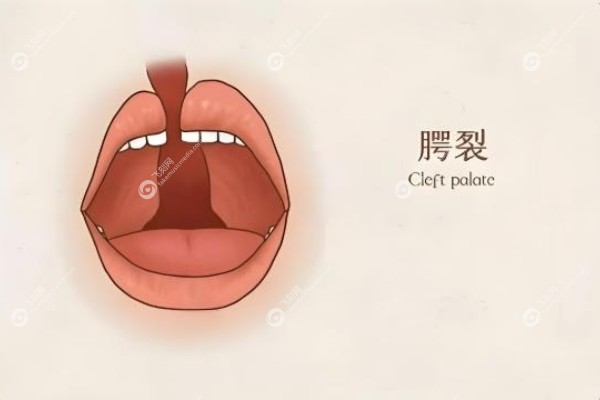 唇腭裂二次修复手术哪里现在免费.jpg