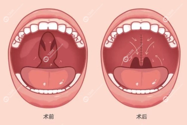 唇腭裂二次修复手术哪里现在免费.jpg