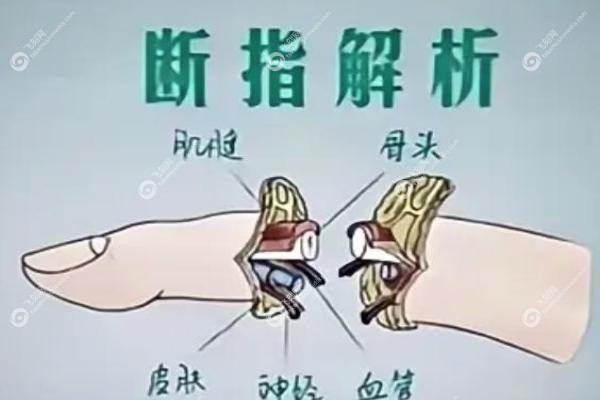 断指再造术大概多少钱.jpg 断指再造术大概多少钱.jpg