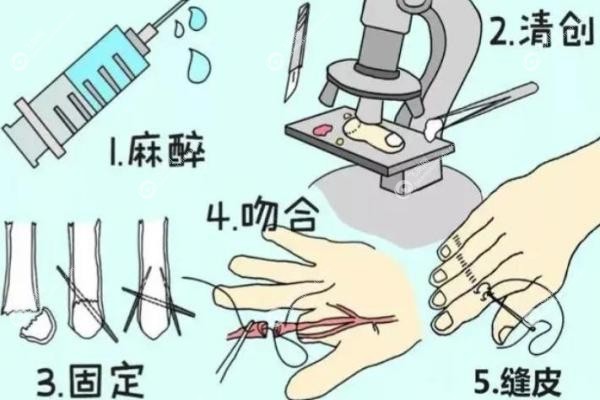 断指再造术大概多少钱.jpg 断指再造术大概多少钱.jpg