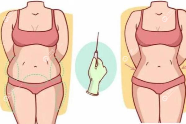 腰腹部吸脂哪个医院好jpg