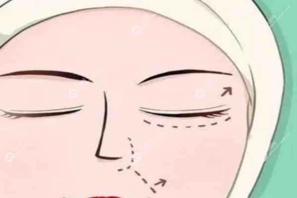 张姣姣双眼皮修复.jpg