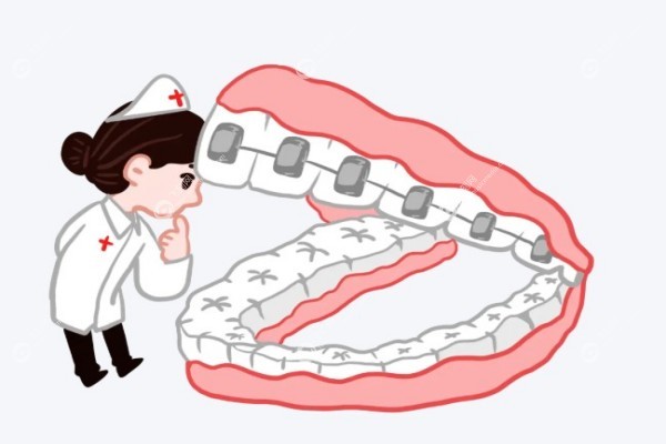 日本拓美自锁托槽怎么样3.jpg