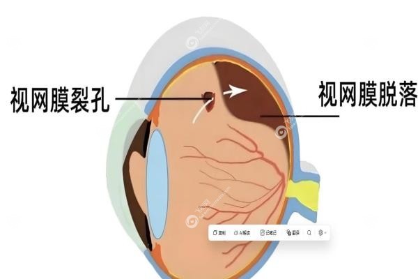视网膜脱落手术费用大概多少钱,医 保报销吗？从1万到5万,这份省心指南请收好