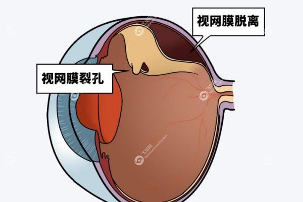 视网膜脱落手术费用大概多少钱,医 保报销吗？从1万到5万,这份省心指南请收好2